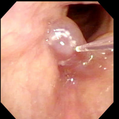 Large vocal cord polyps are lasered. This procedure is not painful and extremely well tolerated.