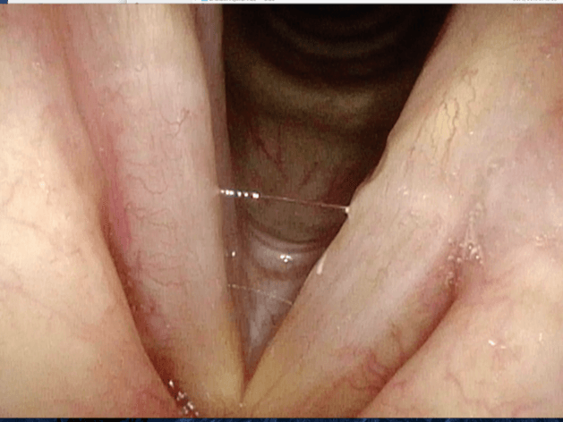 12 weeks AFTER SURGERY: the polyps were surgically removed under general anesthesia while leaving the normal vibratory layer intact. This patient had a normal voice.
