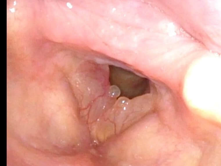 BEFORE TREATMENT: Large and floppy vocal cord polyps (Reinke edema). This female patient sounded very low-pitched and she described her voice as "male like".