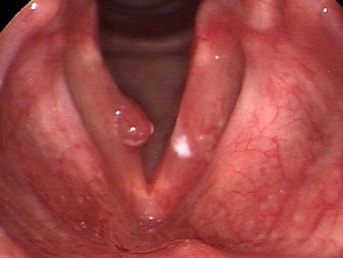 Blood-blister (hemorrhagic vocal cord polyp)
