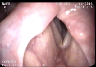 The left vocal cord (right side on image) is immobile after thyroid surgery lead to injury of the vocal cord nerve.
