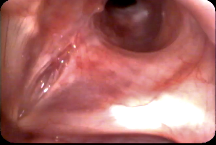 Stricture (stenosis) immediately below the vocal cords (subglottis)